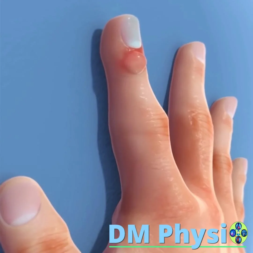 Ганглион на пръстите